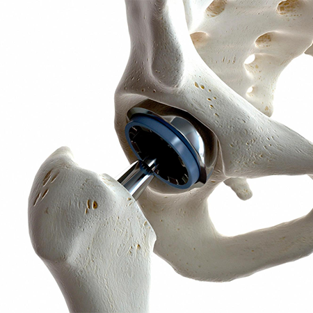 A skeleton model with a metal hip implant.