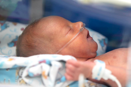 A sleeping neonatal patient with a breathing tube in nose.