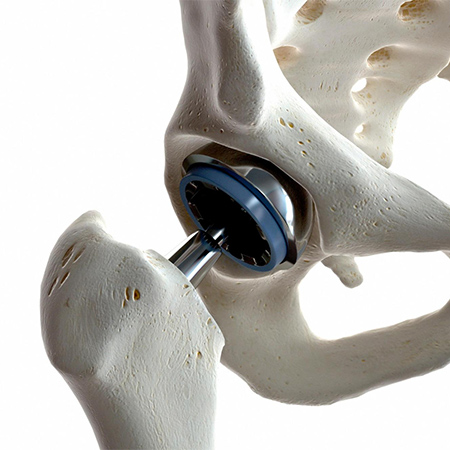 A skeleton model with a metal hip implant.