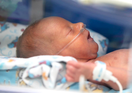 A sleeping neonatal patient with a breathing tube in nose.